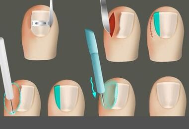 Heqja e gozhdës në prani të një kërpudhat në këmbë