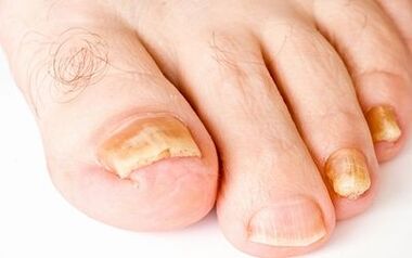 Simptomat e fotove të kërpudhave të thonjve