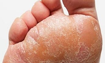 Shenjat dhe simptomat e kërpudhave në këmbë