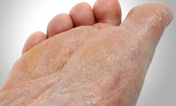 Shtigjet e transmetimit të kërpudhave në këmbë