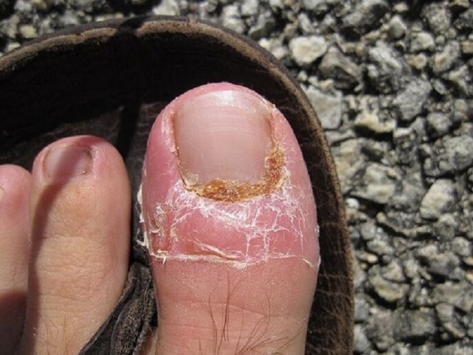 dëmtimi i thonjve dhe lëkurës së gishtërinjve për shkak të një infeksioni mykotik